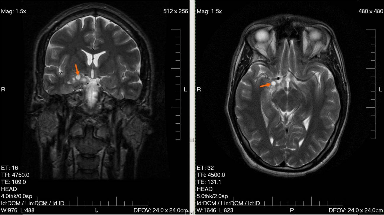 glioma