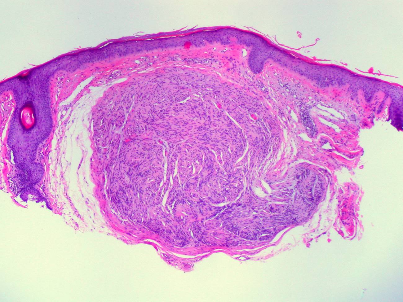 melanoma