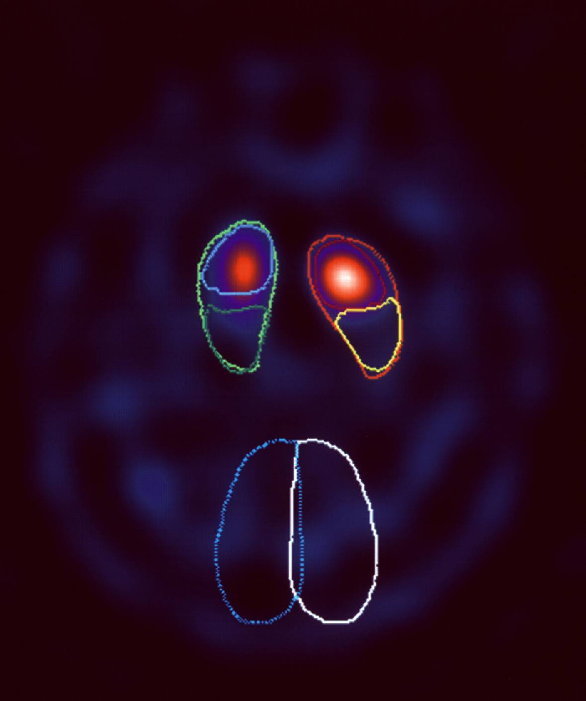 datscan