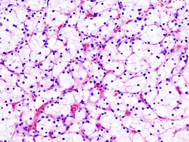 Descubren un nuevo gen implicado en el cáncer de riñón