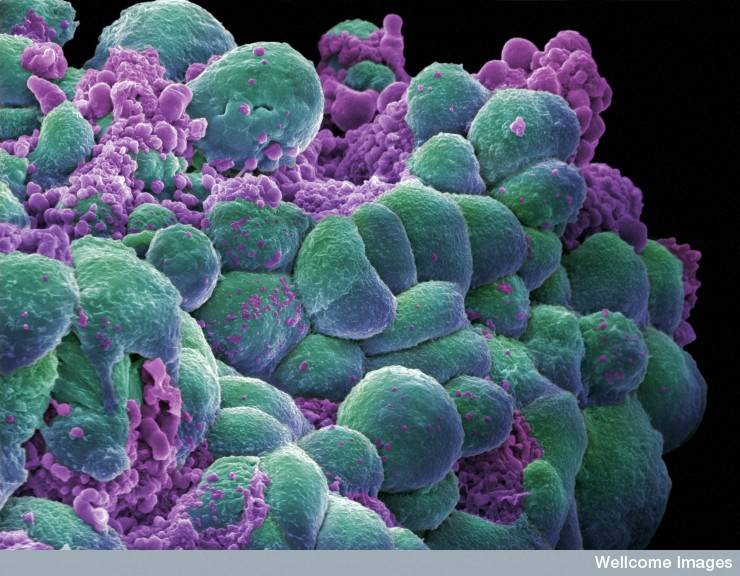 Descubren una proteína que altera la nutrición de células de cáncer de mama