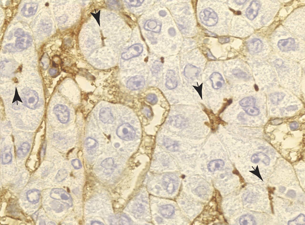 ICAM-1 se confina en la parte apical (flechas) de las células epiteliales de hígado que permanecen sanas y funcionales. Inmunohistoquímica de un hígado infectado con el virus de la hepatitis C. 