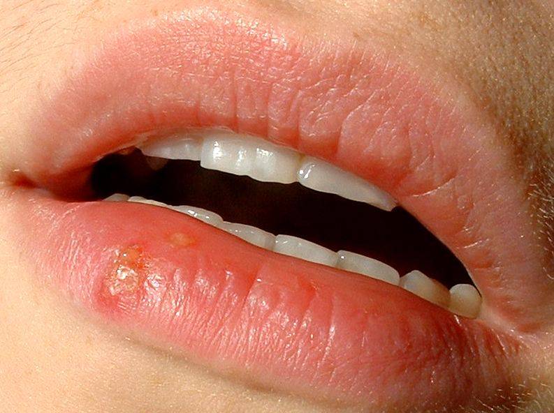 Infección por VHS-I localizada en el labio inferior. Imagen: Wikipedia