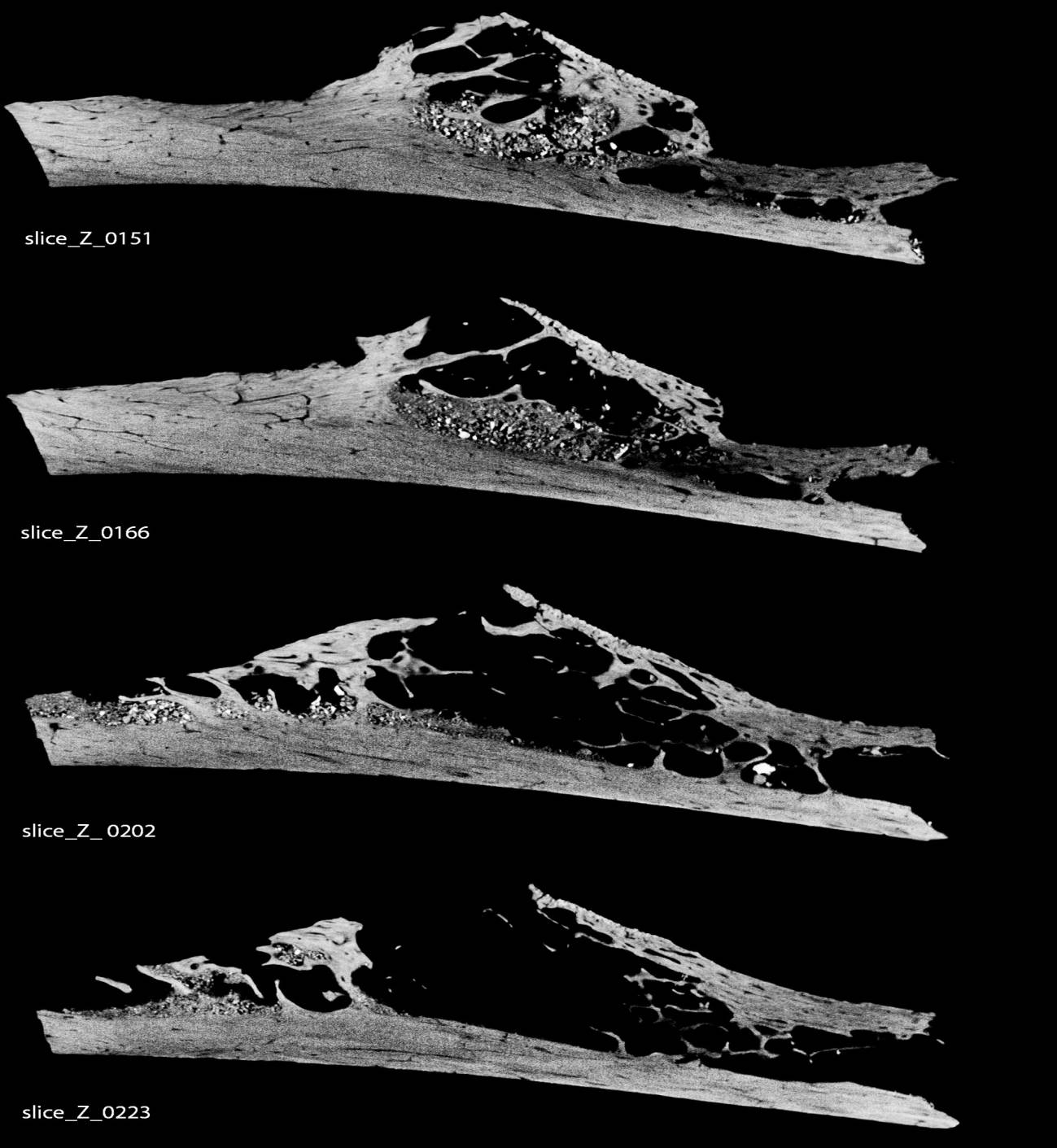 La costilla cancerosa fue recuperada en la famosa excavación arqueológica de la ciudad croata de Krapina. / Penn Museum