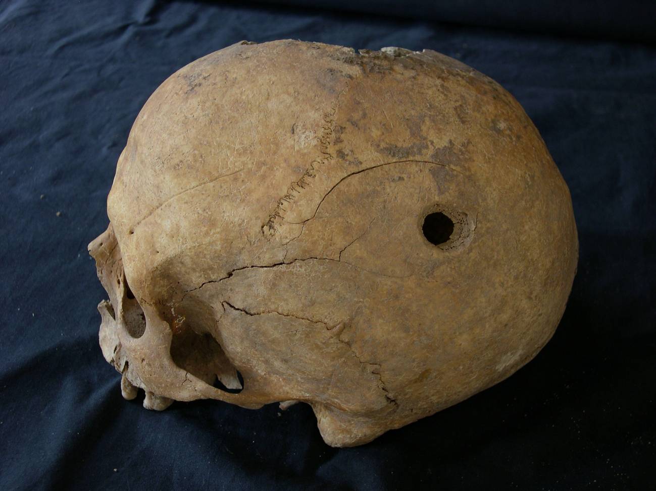 Cráneo trepanado. Imagen: Esther Gómez López.  