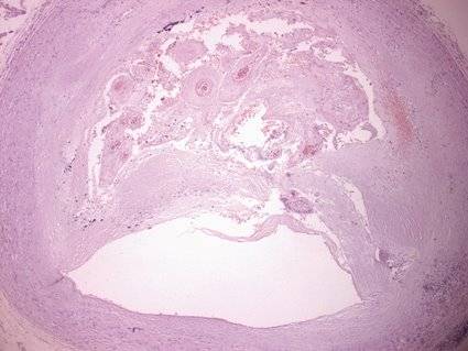 Arteria coronaria