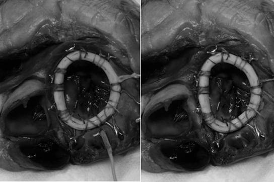 Nuevo sistema para tratar las insuficiencias valvulares cardiacas