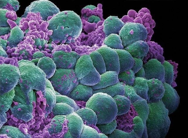 Nace el primer bebé sin un gen que predispone al cáncer de mama