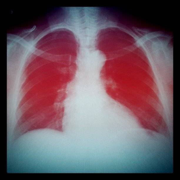 Proteger los pulmones tras la muerte cerebral aumenta los órganos aptos para donación