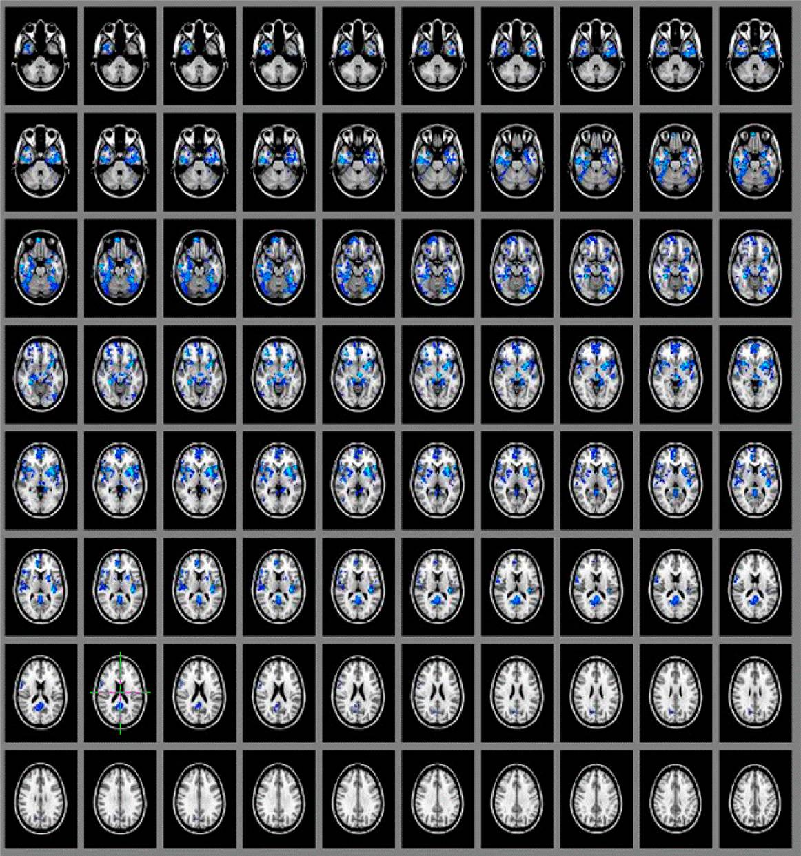 Una vez que el sujeto asimila la psilocibina, se aprecia en el escáner de su cerebro una disminución en el torrente sanguíneo, sobre todo en las zonas centrales, como el tálamo y la circunvolución del cíngulo anterior y posterior. Imagen: PNAS