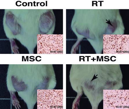 Un tratamiento más efectivo contra el cáncer combina radioterapia y células madre