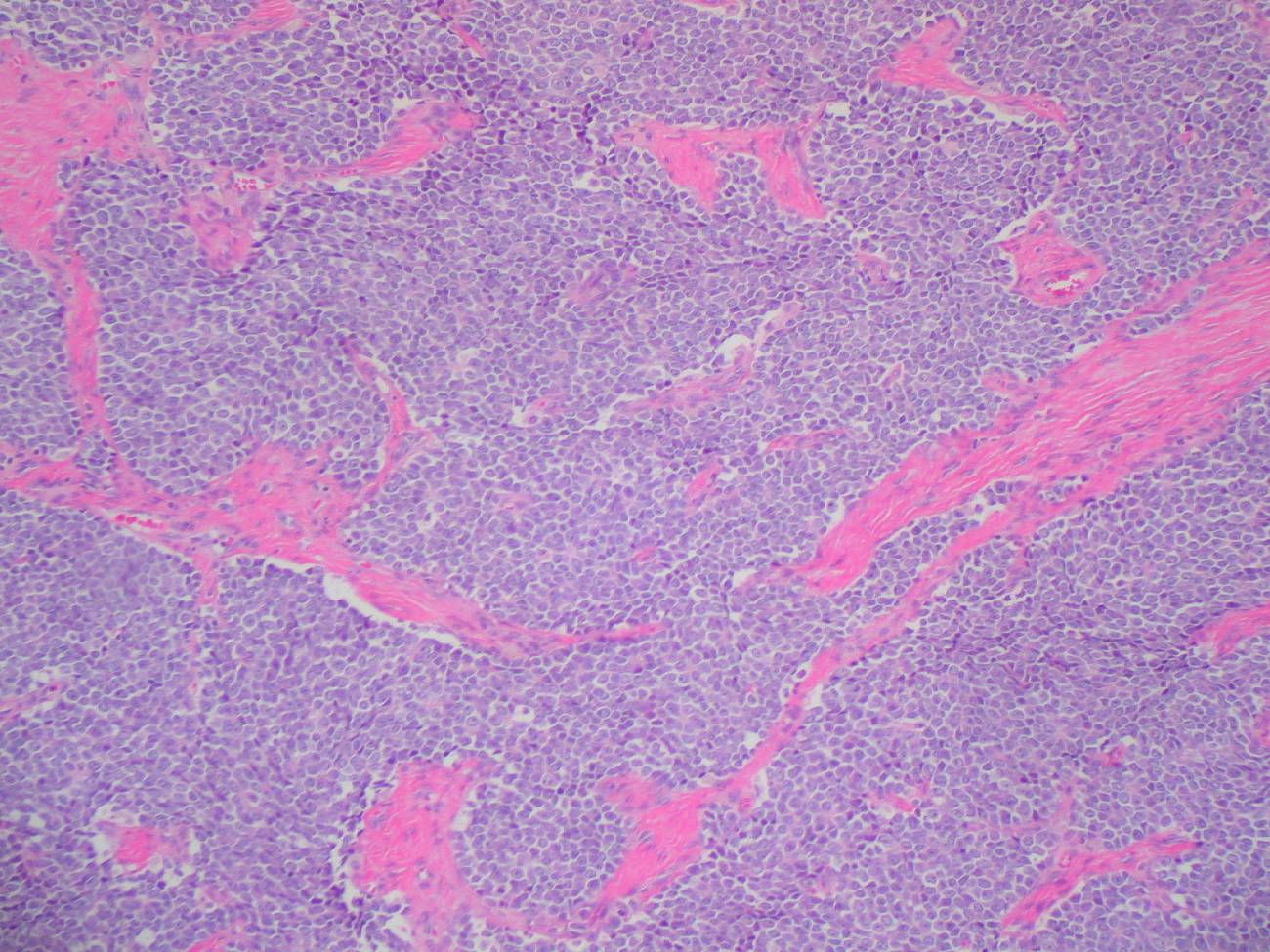 Una proteína de la membrana celular provoca metástasis en un grave cáncer infantil