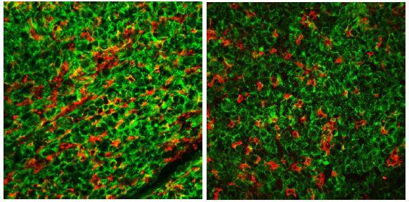Tumor con y sin caveolina-1.