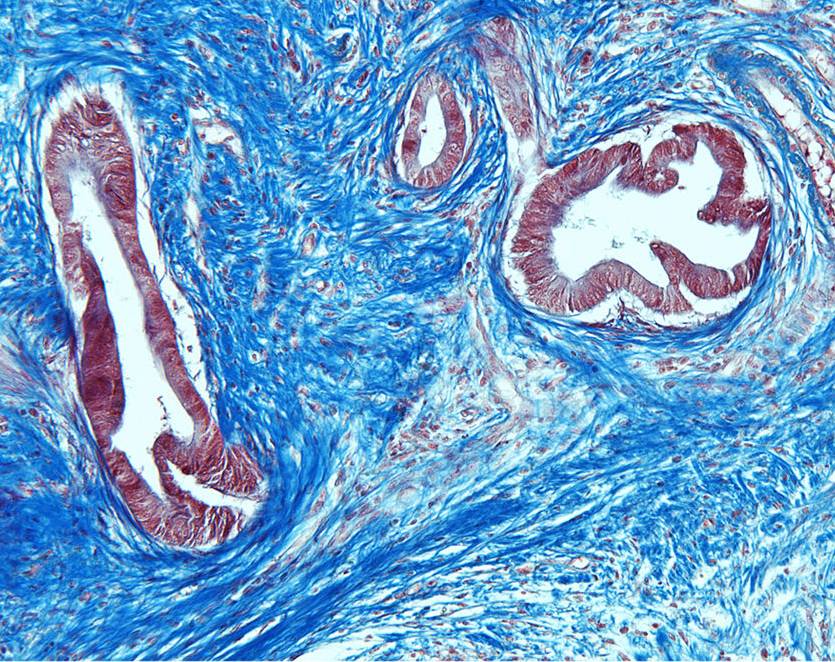 Las células que rodean los tumores favorecen la iniciación, la progresión y la diseminación del cáncer