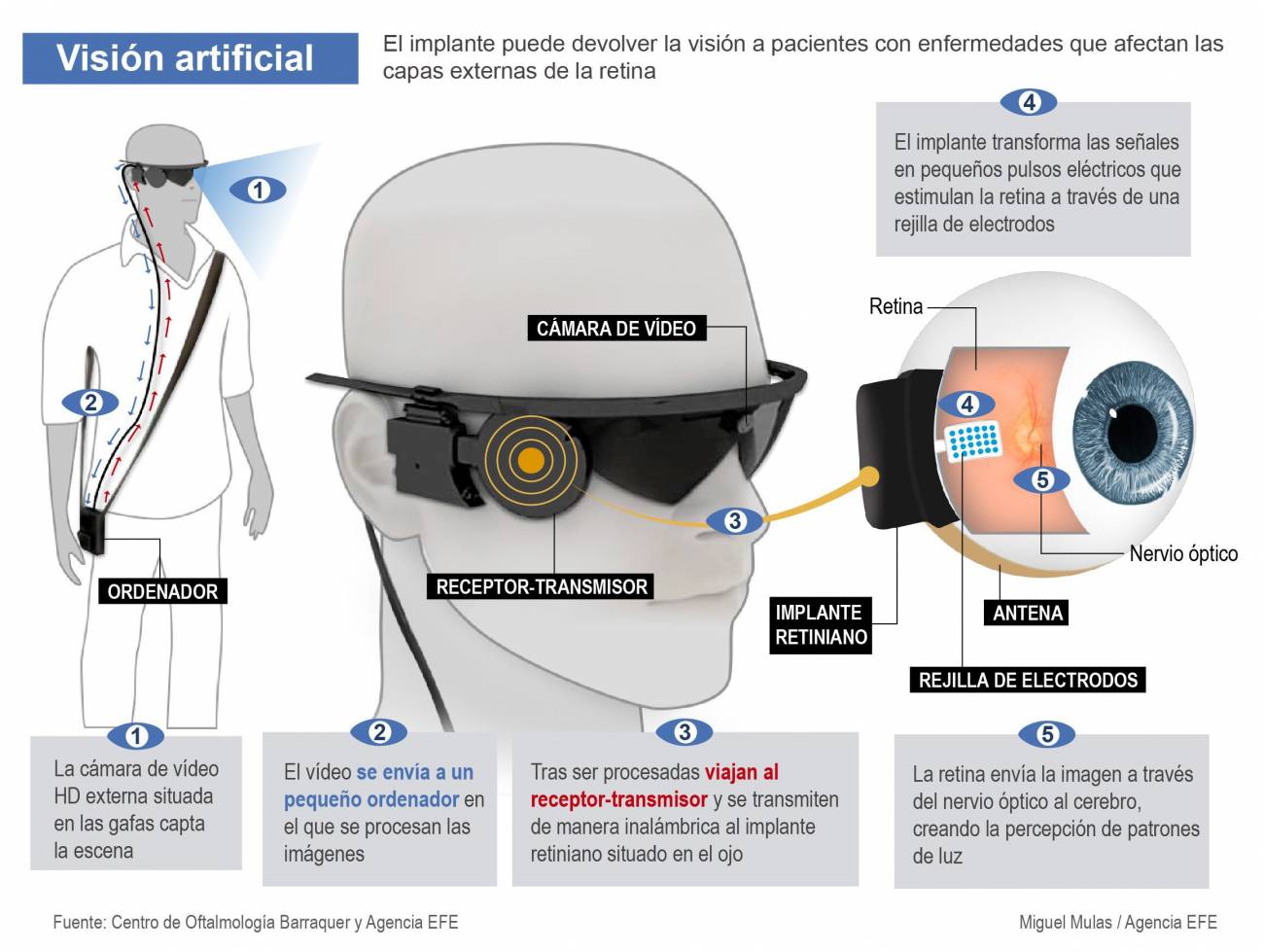 En esta infografía se explica qué y cómo funciona un ojo biónico./ Efe