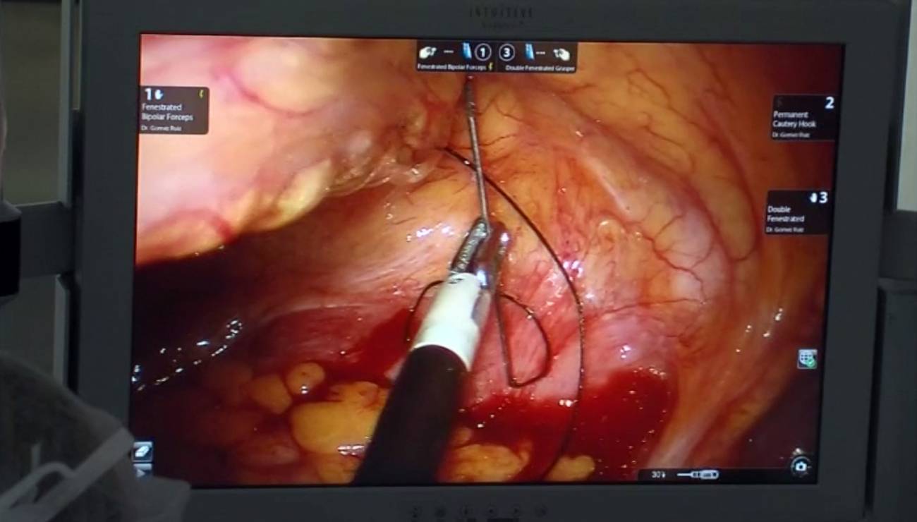 Intervención en tumor de recto.