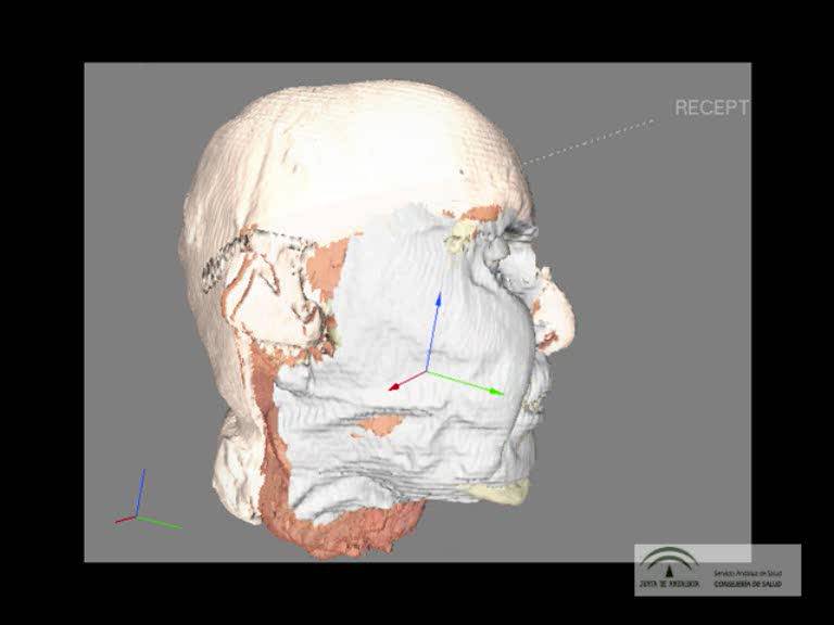 Explican la planificación quirúrgica del trasplante de rostro de Sevilla