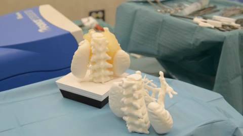 Extirpan un tumor tras ensayar con una maqueta en 3D.