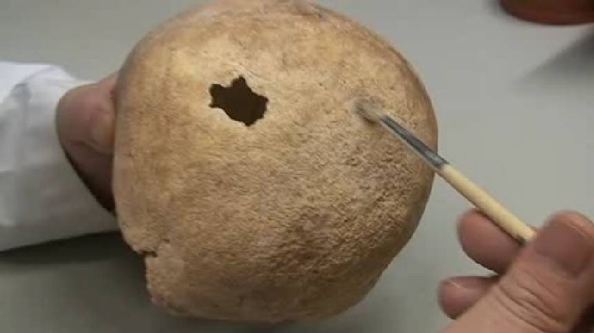 Hallan el primer cráneo en España que liga una trepanación a una dolencia