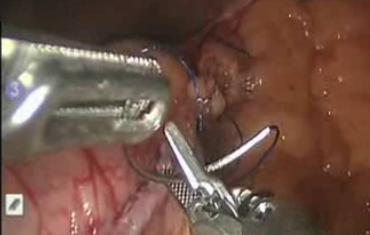 Técnica de cirugía robótica