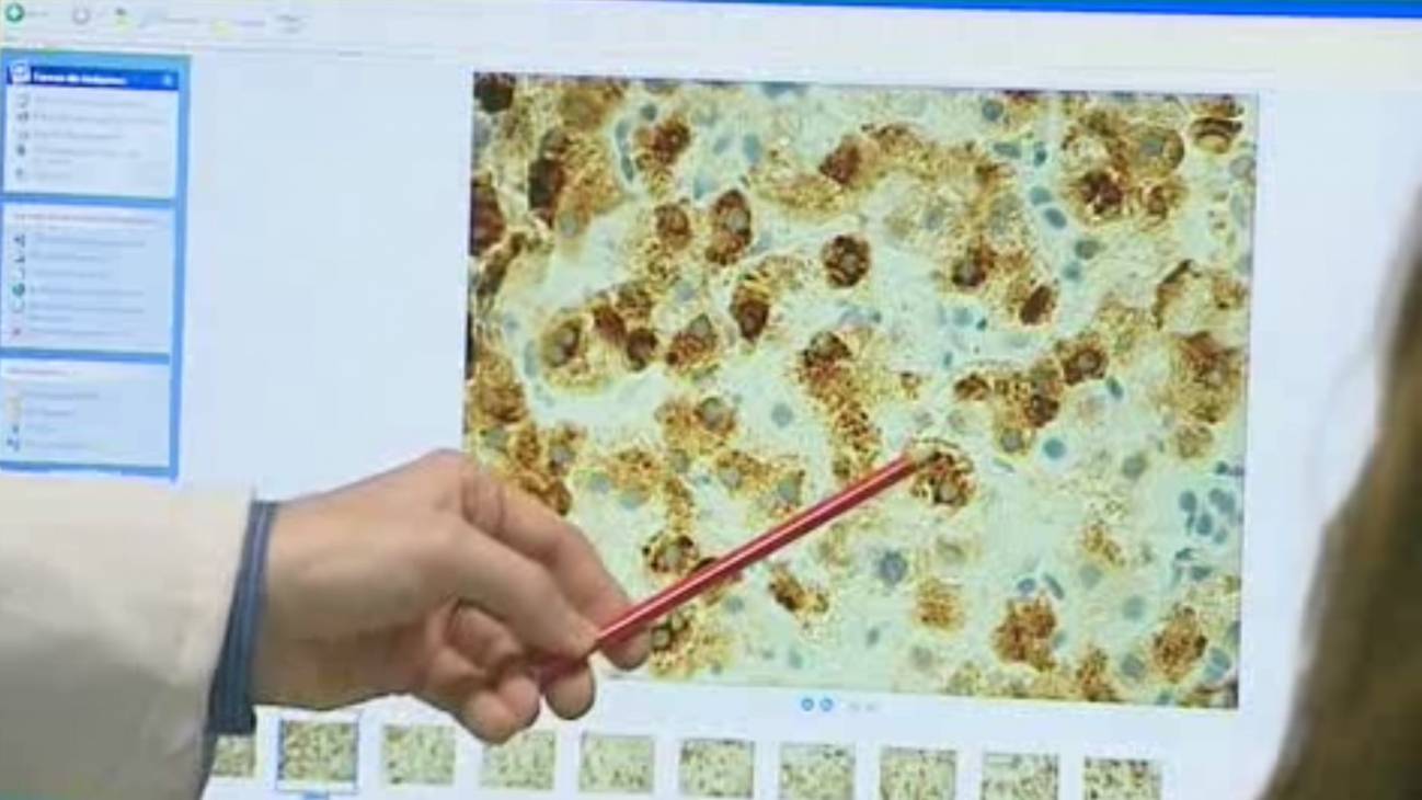 Los fármacos antivirales orales curan el 95% de las hepatitis