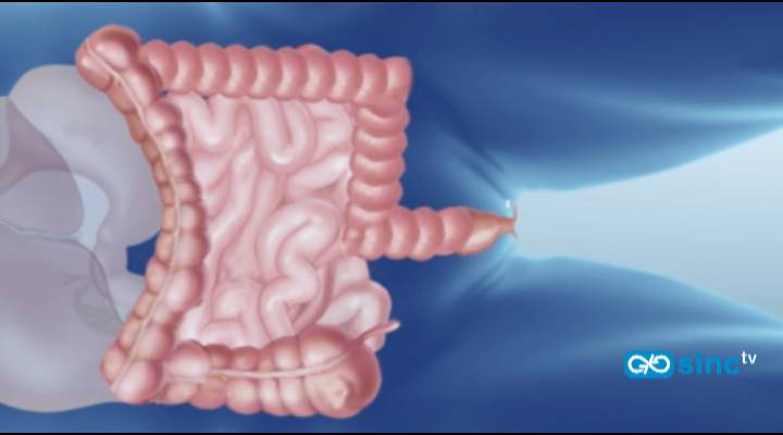 Extracción de colon por el ano