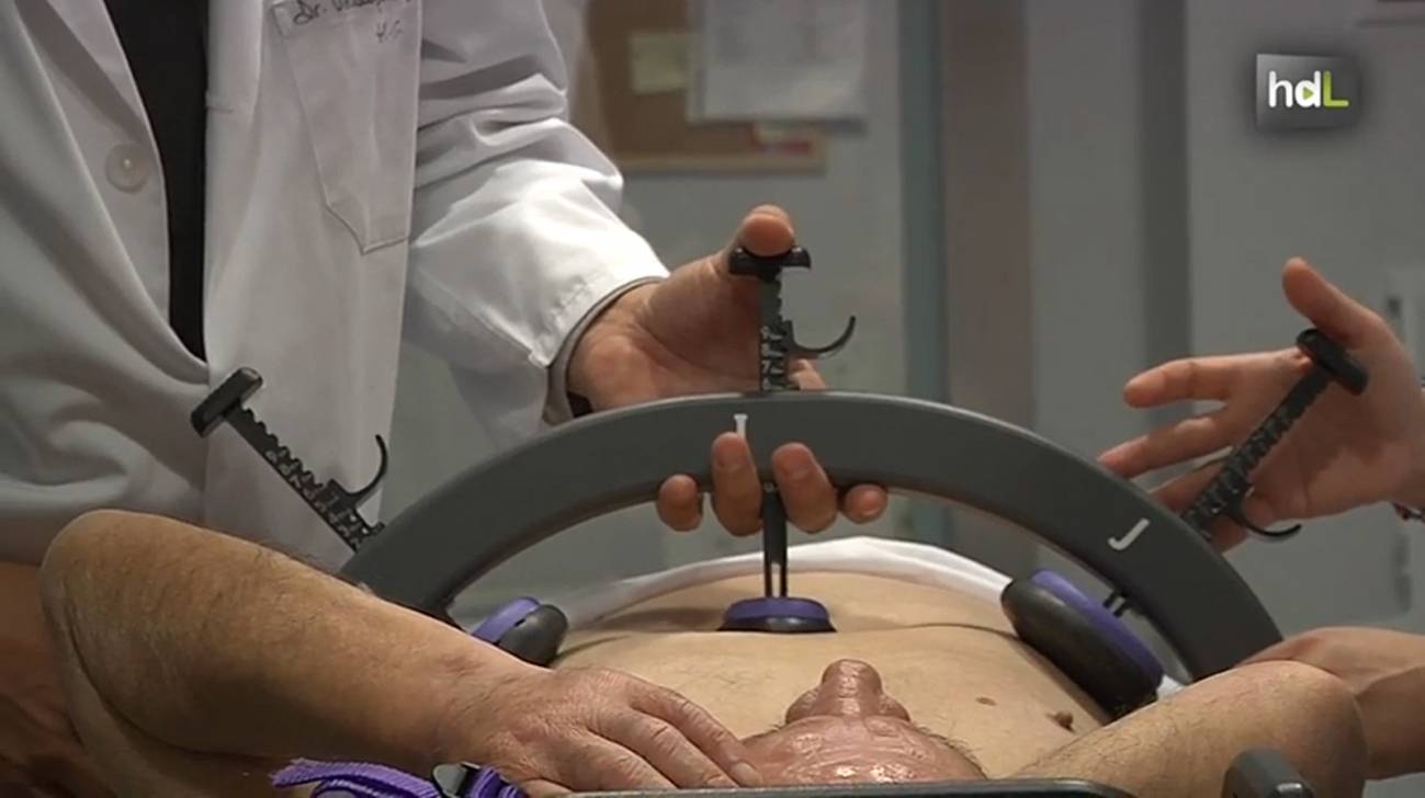 Dispositivo que reduce el número de sesiones de radioterapia. 