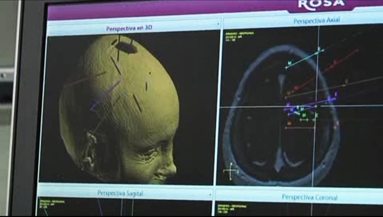 Un robot permite intervenir a pacientes epilépticos