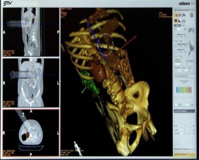 Un simulador prevé las consecuencias de la radioterapia