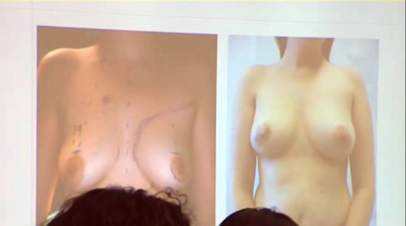 Una técnica reconstruye de una vez el pecho, el pezón y la areola