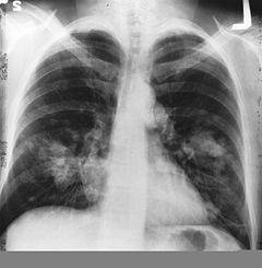 Algunos pacientes de cáncer de pulmón podrán recibir tratamiento oral en vez de quimioterapia convencional