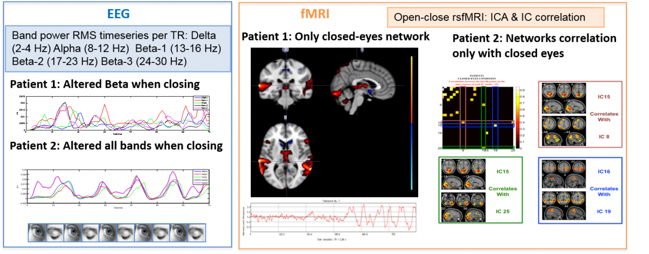 Analizar las alteraciones en las señales neuronales mejora el diagnóstico de la epilepsia