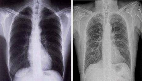 Asocian niveles altos de bilirrubina con un menor riesgo de sufrir cáncer de pulmón