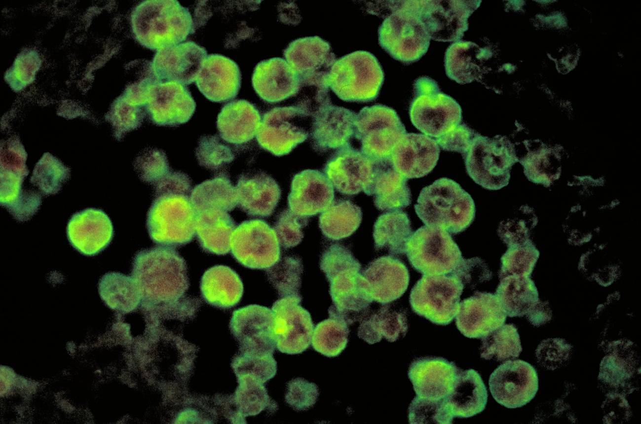 Histopatologia de la meningoencefalitis amébica