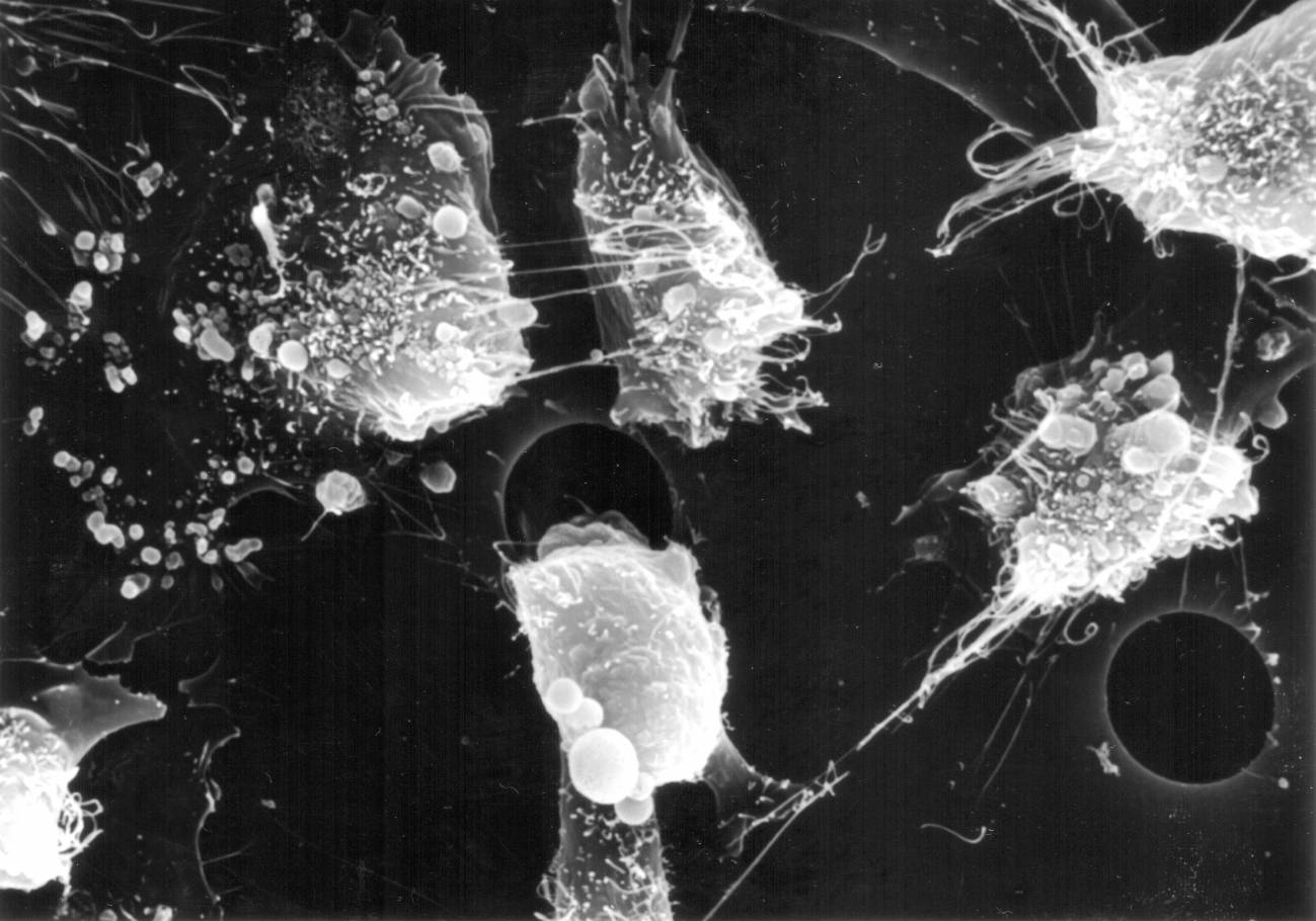 Búsqueda de nuevos marcadores pronóstico y fármacos antitumorales para el melanoma