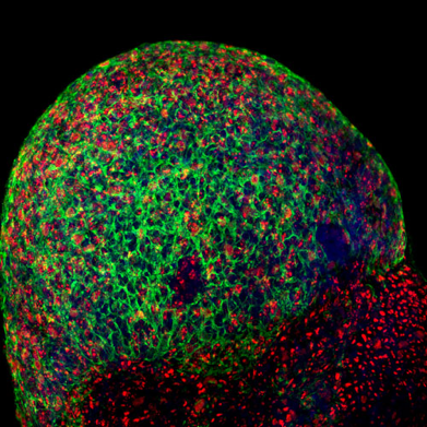 Cómo estudiar la relación entre enfermedades neurodegenerativas distintas