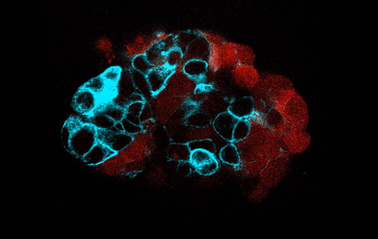 Organoide de tumor colorrectal
