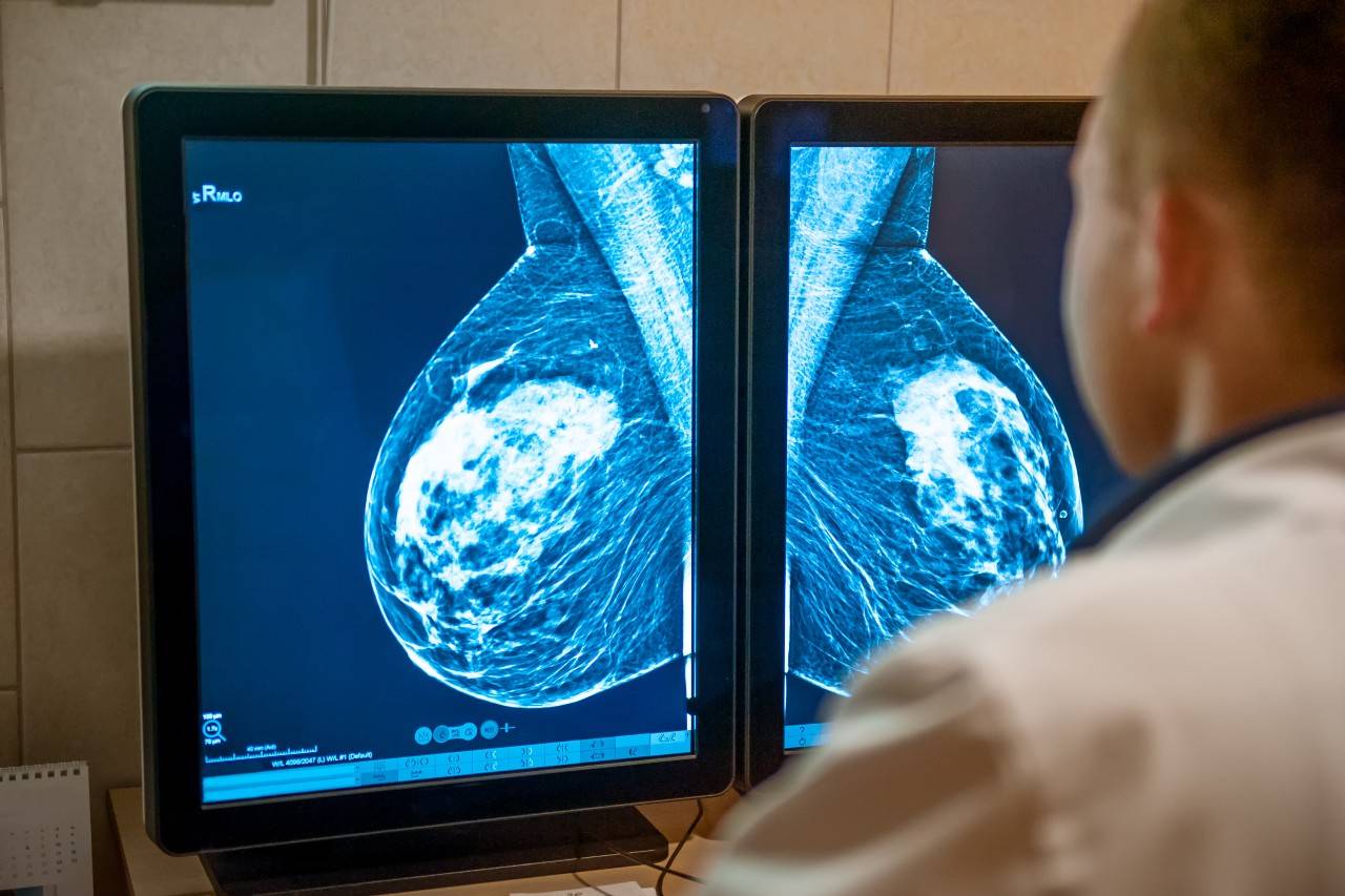 Las tasas de supervivencia a cinco años del cáncer de mama alcanzan ya el 86 %