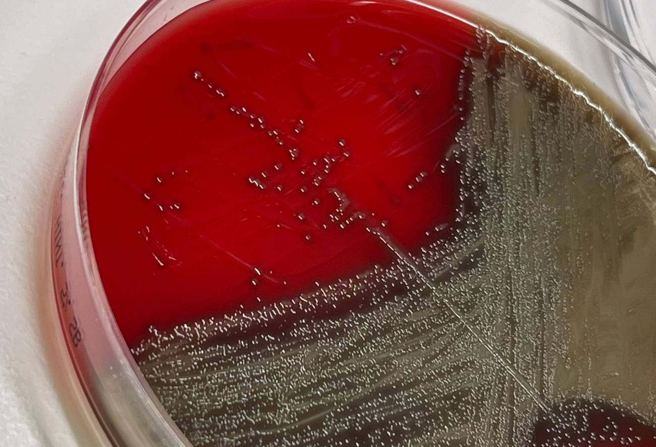 Cómo se ha expandido en España un serotipo de neumococo con gran capacidad de infección