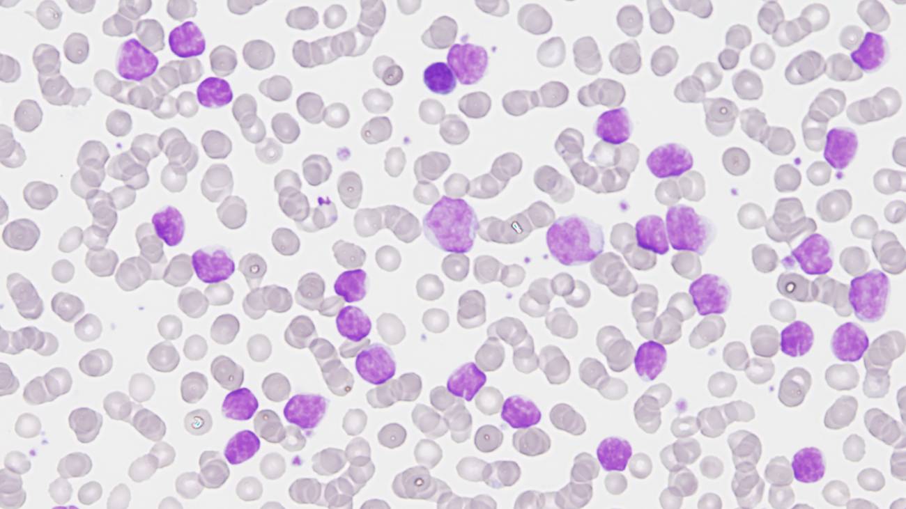 leucemia