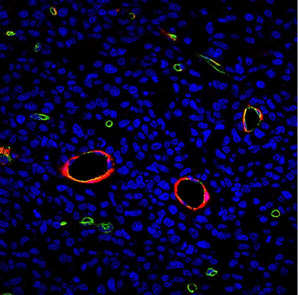 Conexión entre un tipo de tumor cerebral y las enfermedades neurodegenerativas