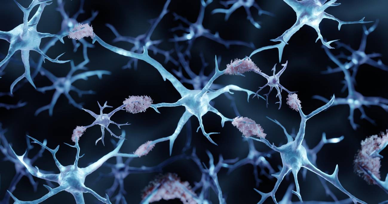 Agregados de placas amiloides en la enfermedad del Alzheimer