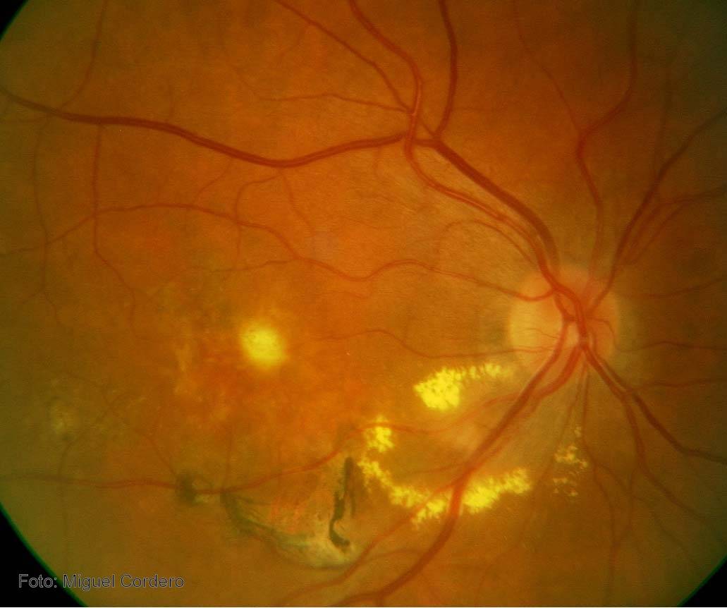 Crean un protocolo para facilitar el tratamiento de un tipo de inflamación ocular