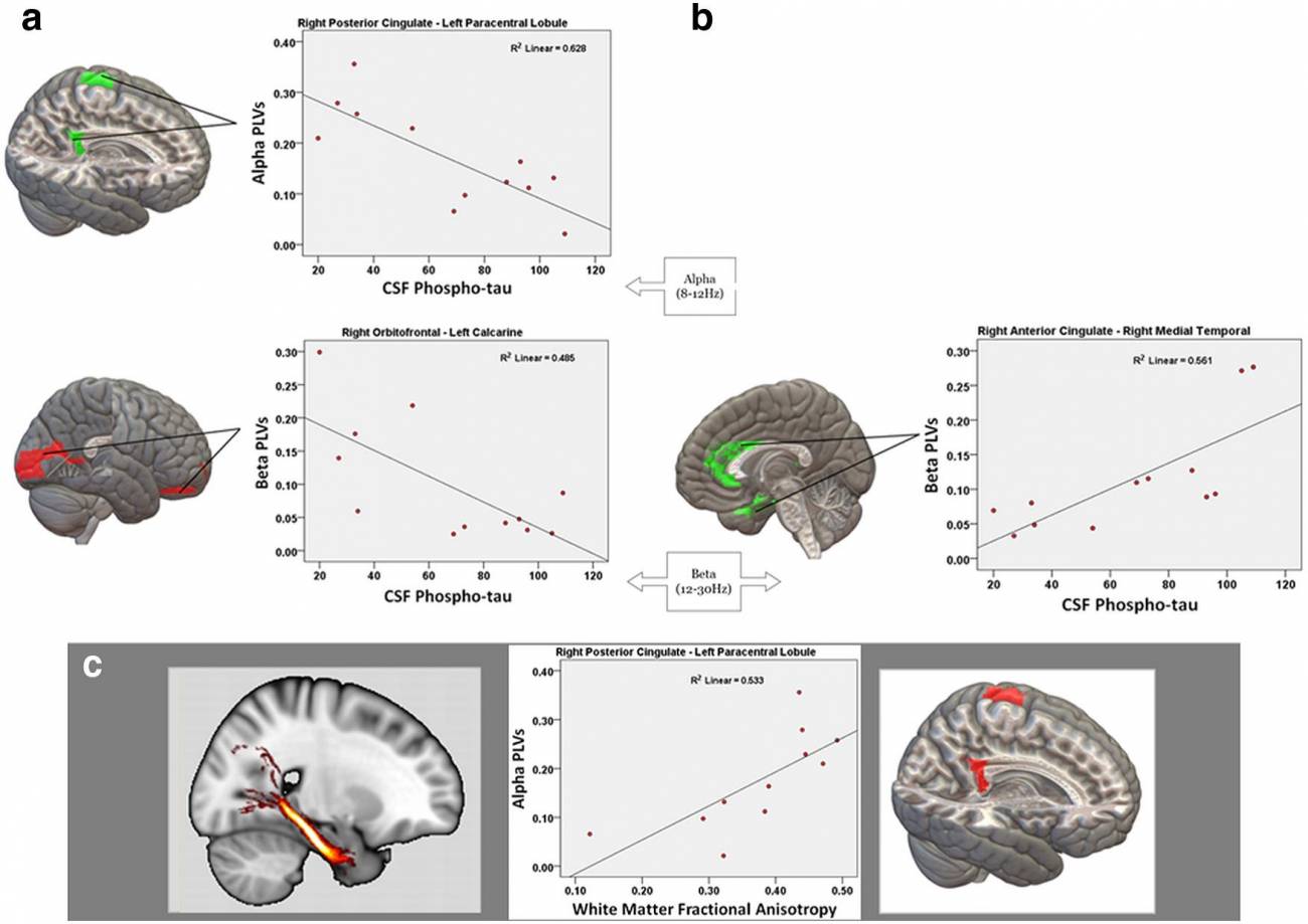 Desarrollan un biomarcador para la enfermedad de Alzheimer