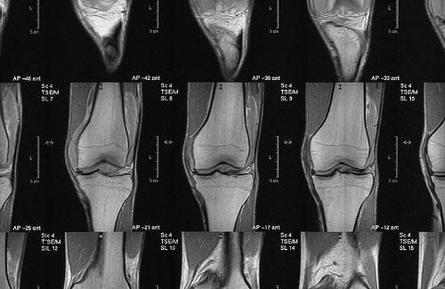 Ruptura completa de ligamento cruzado anterior. Foto: Mauricio Giraldo