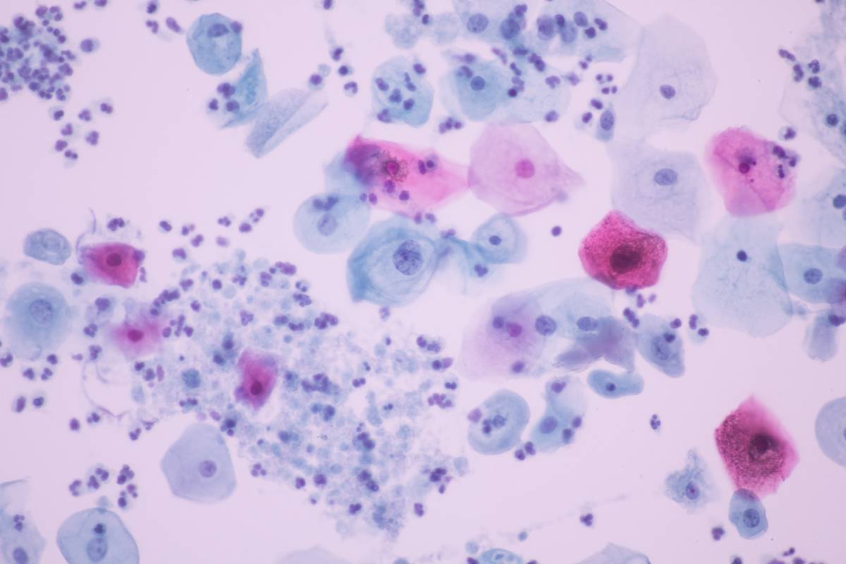 Desarrollan un sistema de IA para detectar una de las infecciones sexuales más frecuentes del mundo