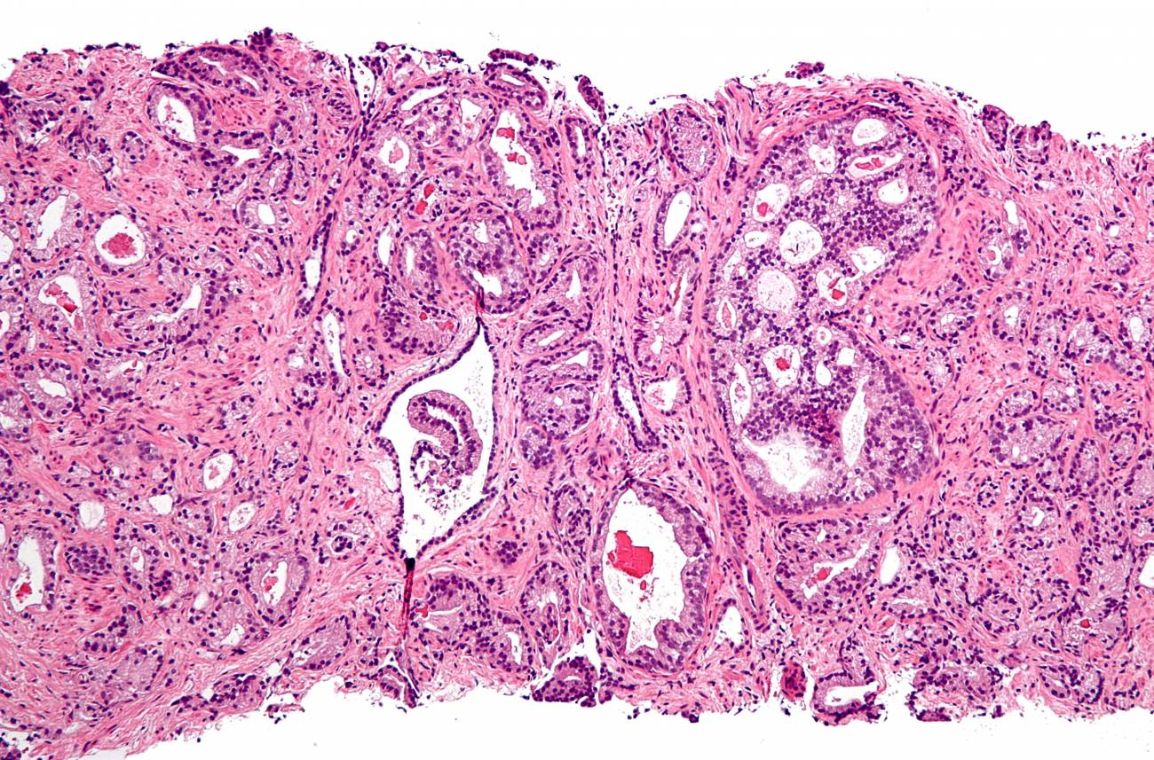 Descifran el genoma de siete tipos de cáncer de próstata