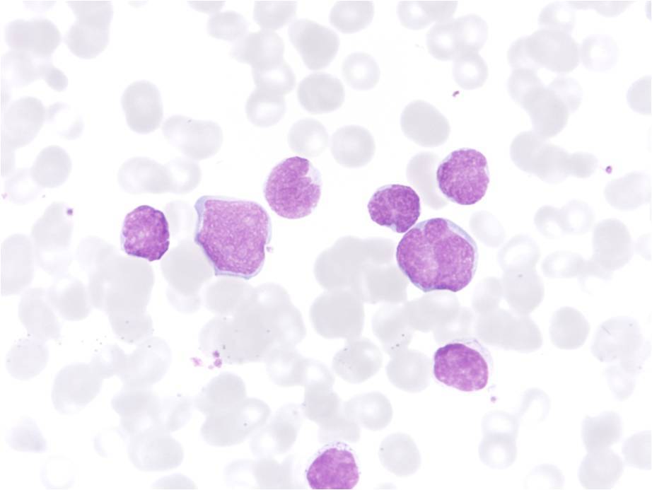 leucemia