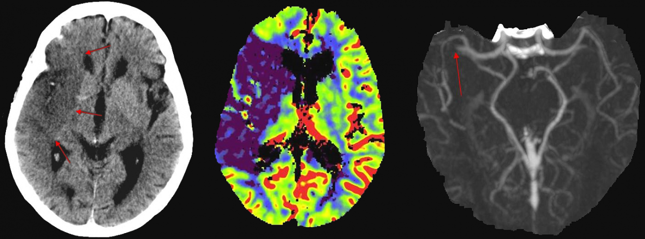 Imágenes de las consecuencias sobre el cerebro