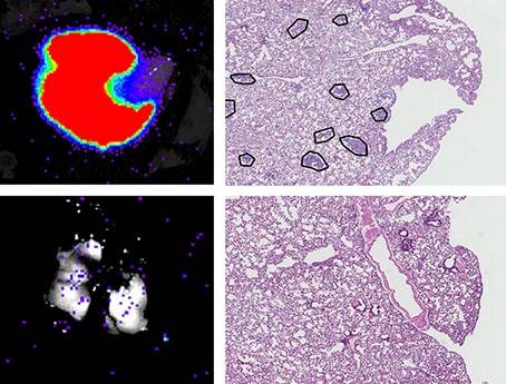 metástasis de células de cáncer de mama